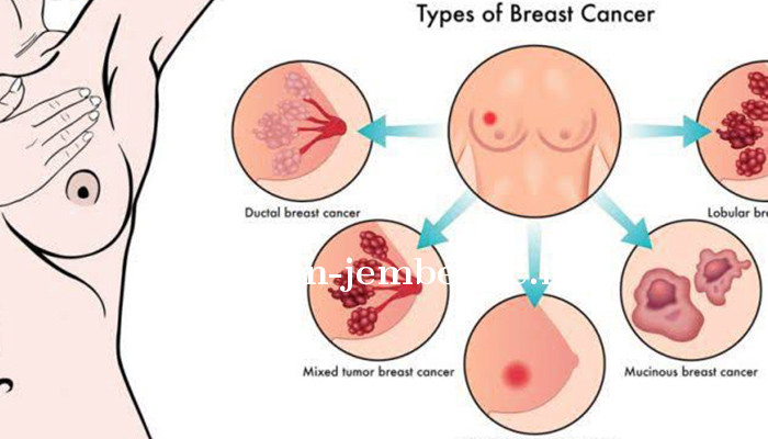 kanker-payudara.jpg